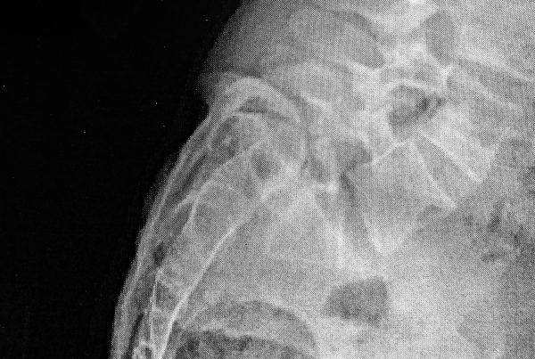 metodo sanrocco chiropratica